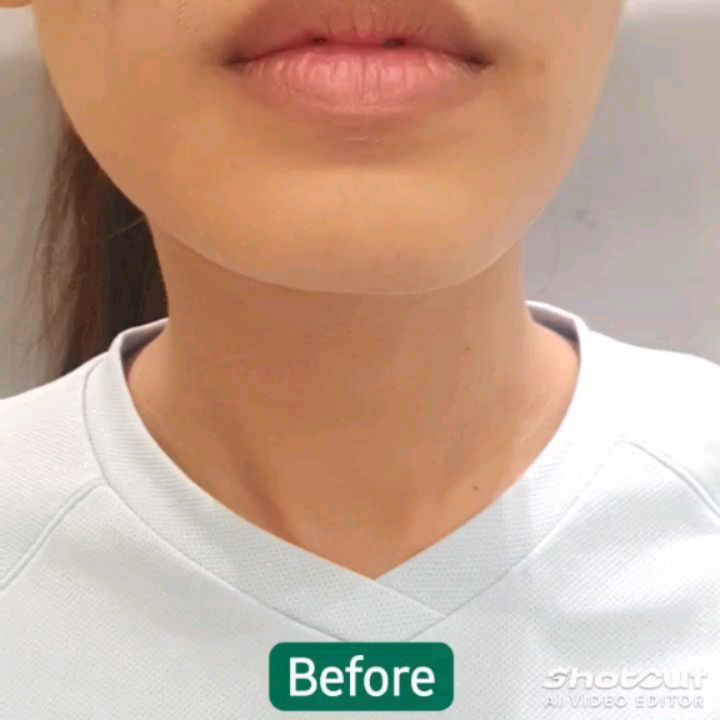 การฉีดฟิลเลอร์ปรับรูปหน้าที่ Ugly Duck Clinic