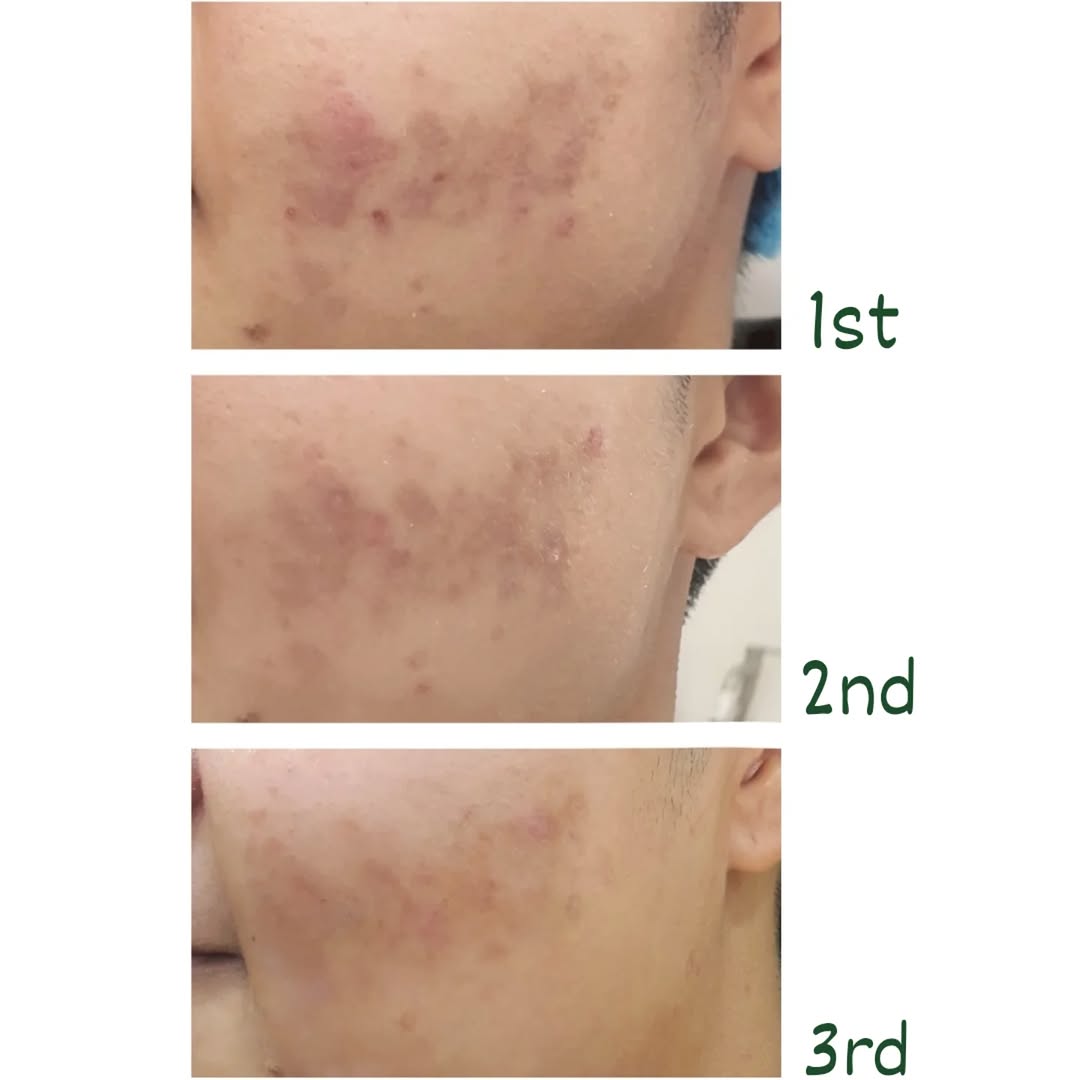 การร้อยไหมยกกระชับที่ Ugly Duck Clinic