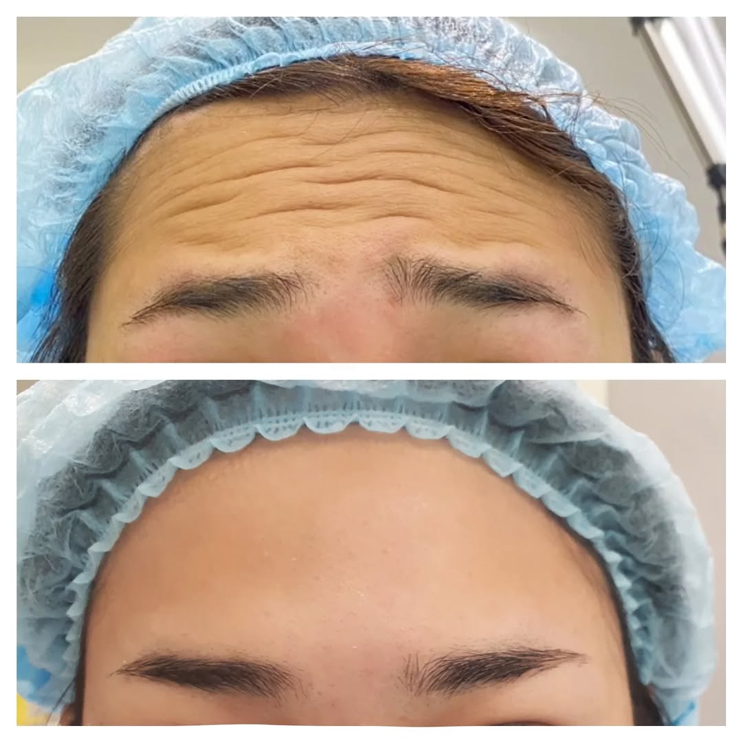 การฉีดโบท็อกซ์ที่ Ugly Duck Clinic